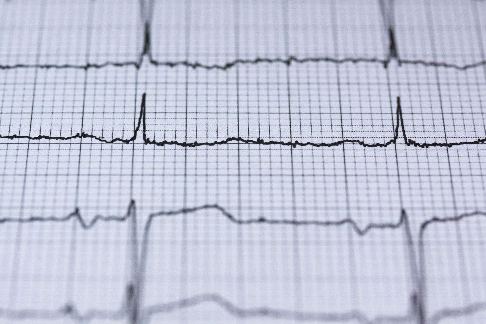 Close-up of heartbeat lines printed on graph paper.